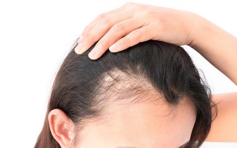 Why Is My Hair Thinning?